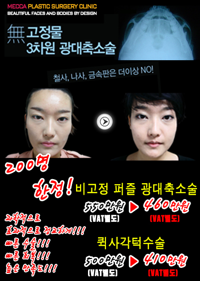 광주성형외과 안면윤곽 200명한정!!!